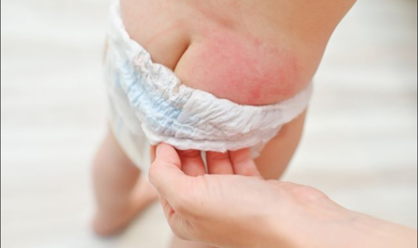 Cara Ampuh Atasi Ruam Popok pada Bayi