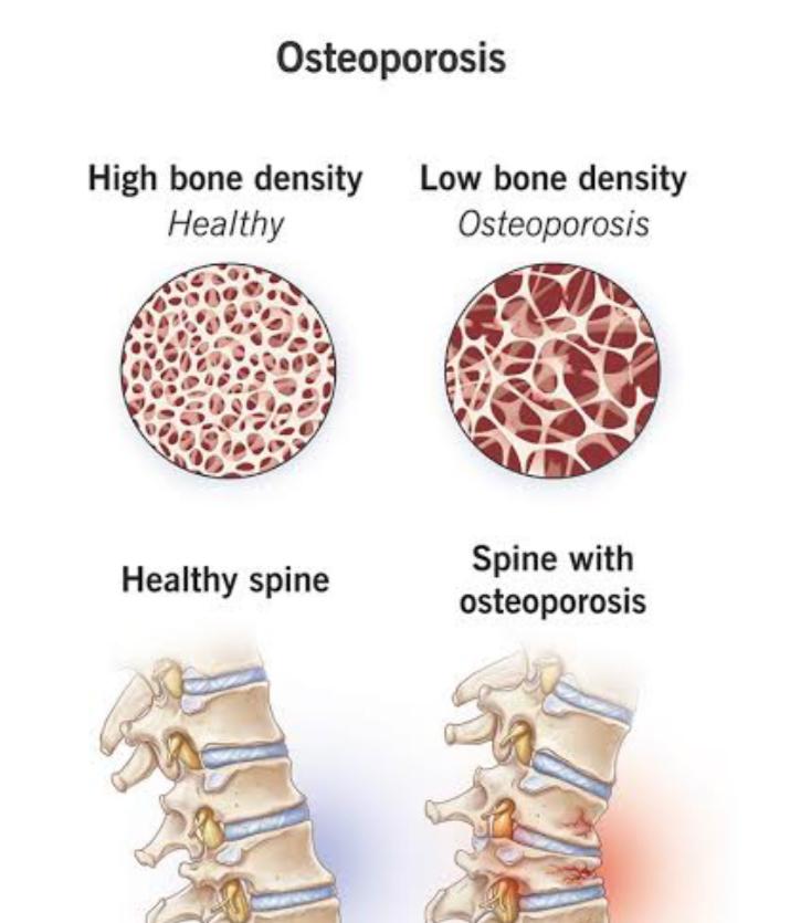 Manfaat Konsumsi Daging bagi Lansia, Termasuk Cegah Osteoporosis