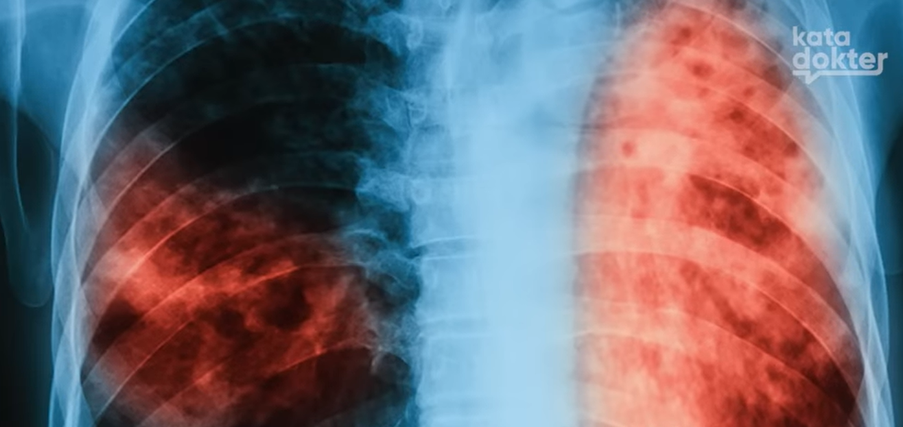 Bahan Alami untuk Mempercepat Penyembuhan Flek Paru-paru-Kata Dokter