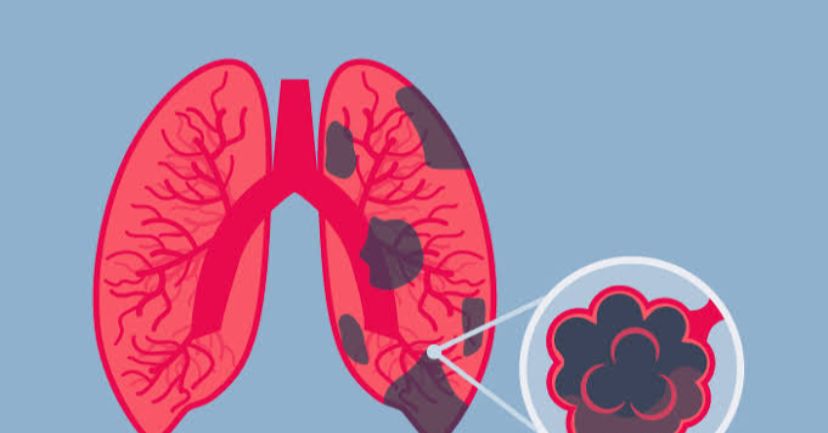 Konsumsi Tiotropium Untuk Obati Penyakit Paru Kronis, Lalu Bagaimana Efek Sampingnya