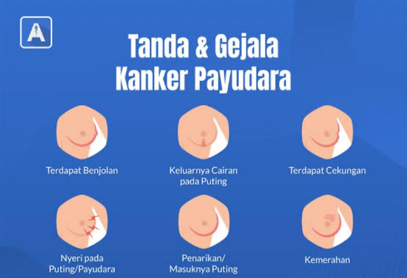 Jarang Disadari  Gejala Ini Bisa Menyebabkan Penyakit Kanker Payudara