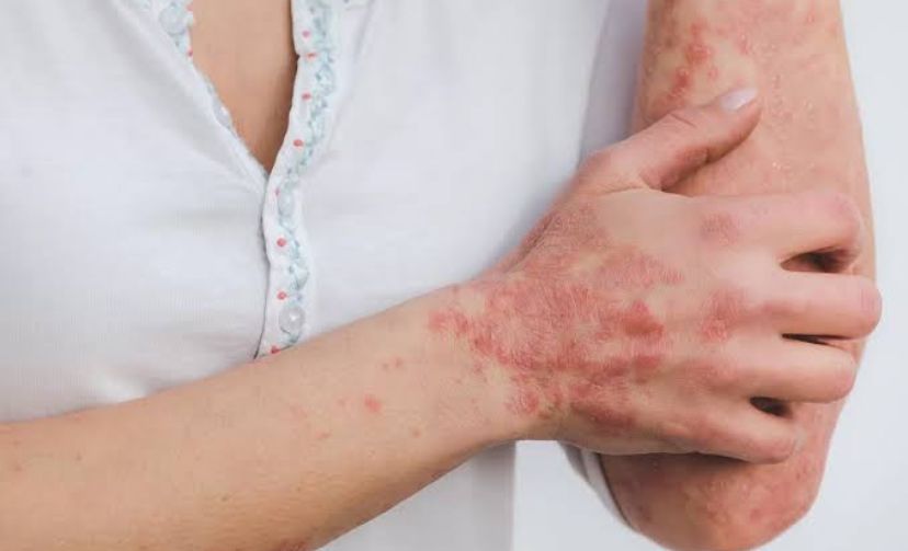  5 Perawatan Diri di Pagi Hari Untuk Penderita Psoriasis