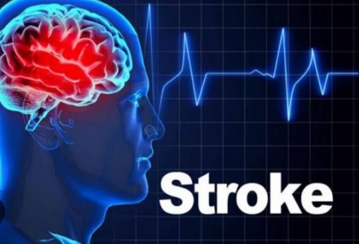 Atasi Stroke Ringan dengan Menggunakan 5 Pengobatan Alami Ini