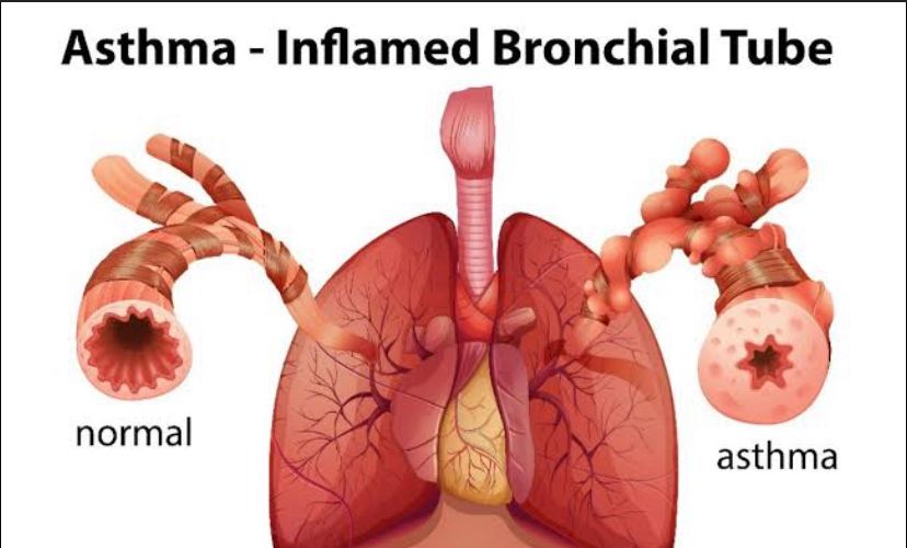 5 Rahasia Pengobatan Asma Dengan Ramuan Herbal Yang Jarang Diketahui