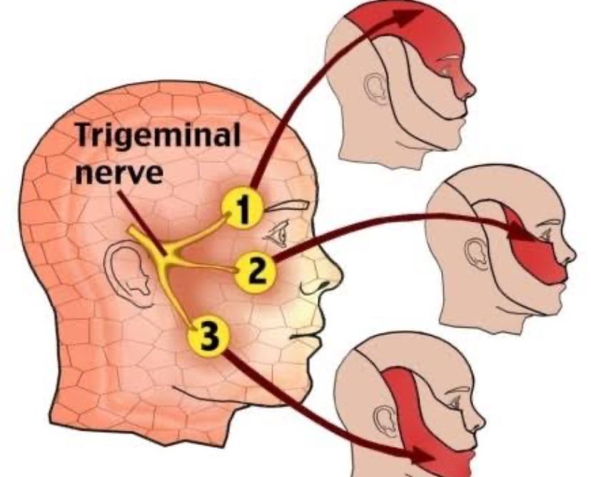 Waspadai Penyakit Trigeminal Neuralgia, Nyeri Berbahaya di Wajah