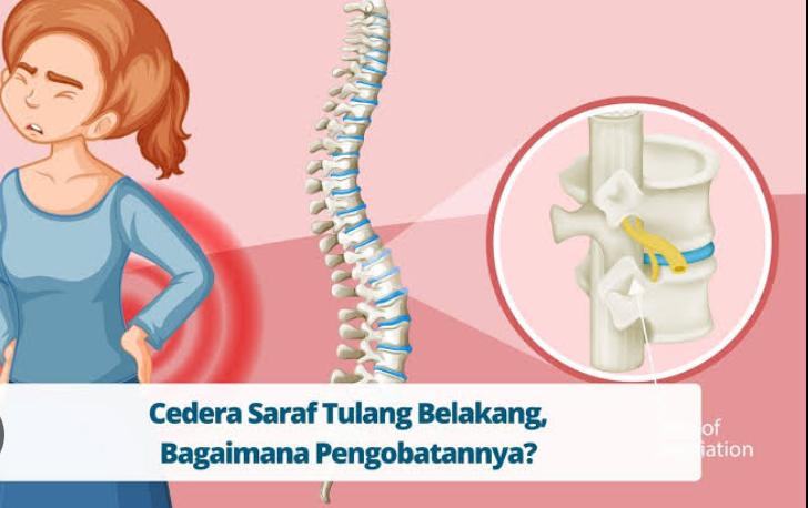 Ini Penyebab Cedera Saraf Tulang Belakang, Simak Cara Pengobatannya