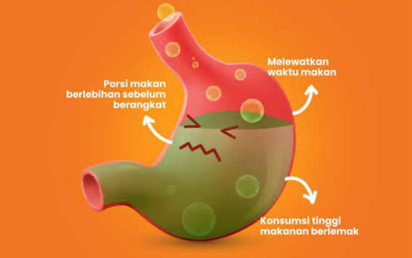 Mudik Aman Bagi Penderita GERD, Simak Saran Dokter