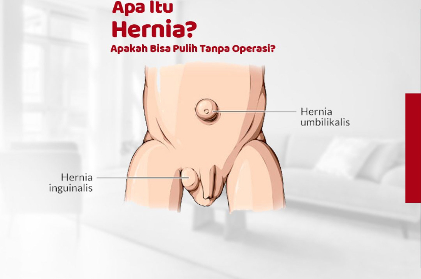 3 Pengobatan Alami untuk Penderita Hernia