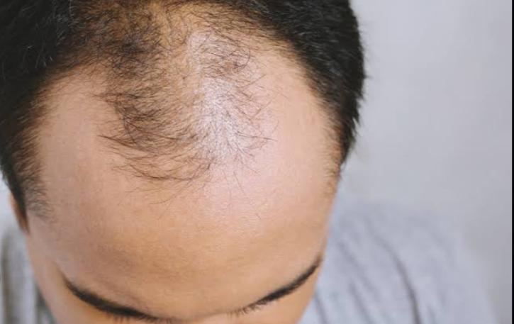 Waspadai Kebotakan Pada Rambut Saat Usia Masih Muda, Kenali Penyebabnya