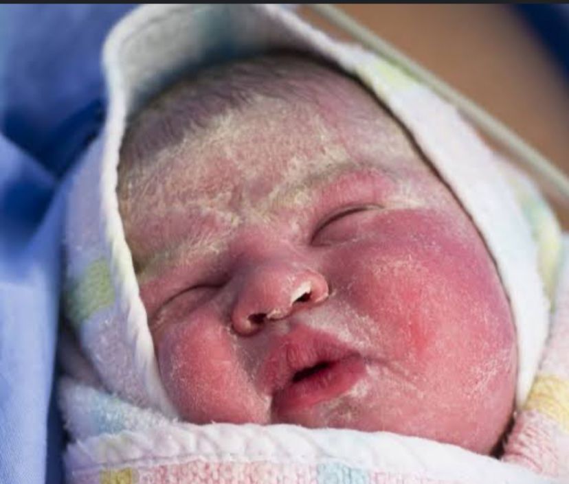 Kebiasaan Bayi Yang Baru Lahir Kulit Mengelupas, Berikut Ini Cara Mengatasinya?