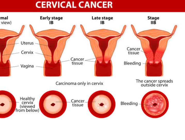 5 Hal yang Harus Anda Ketahui Mengenai Kanker Serviks