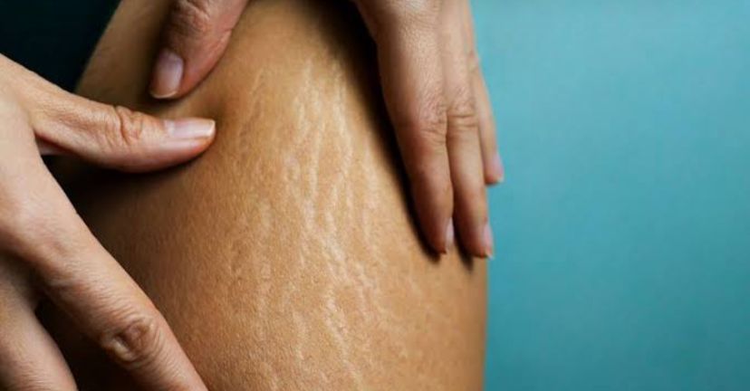 Simak Tips Mencegah dan Mengatasi Stretch Mark