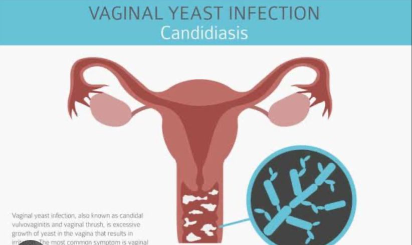 Obati Jamur yang Menyerang Daerah Kewanitaan dengan 5 Bahan Alami Ini