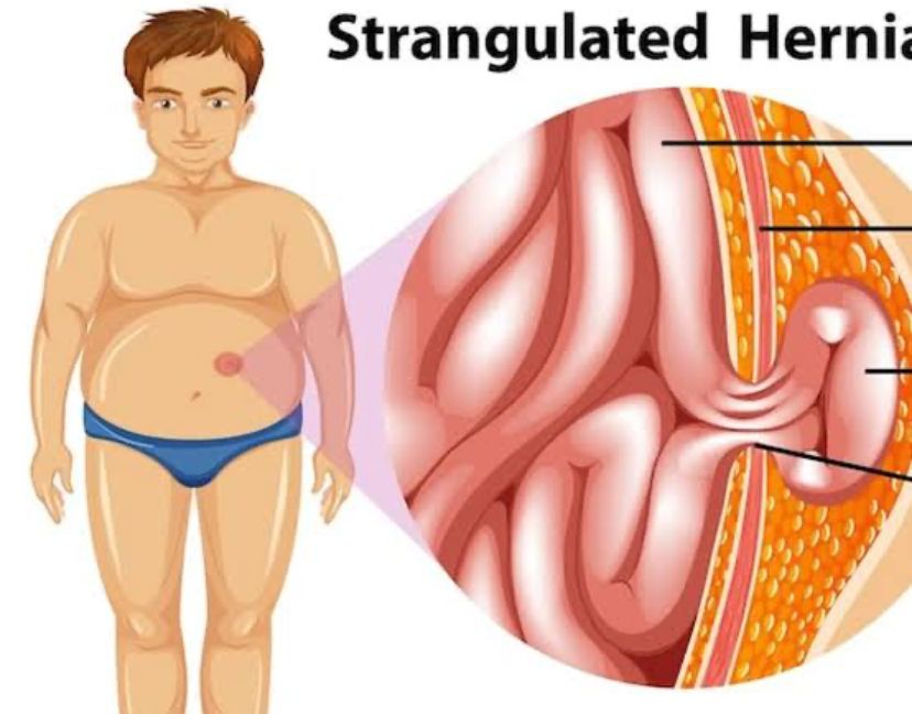 Hernia Dapat Mengganggu Kesehatan Pria, Atasi Dengan 5 Obat Alami Ini