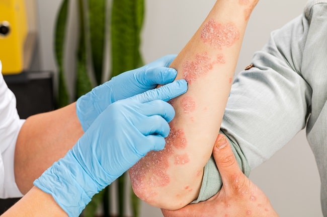 Psoriasis Vulgaris, Penyakit Gangguan Kulit yang Sering Terabaikan dan Faktor Penyebab yang Perlu Anda Ketahui