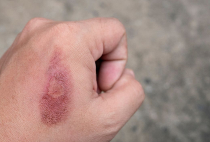 3 Cara Tepat Atasi Luka Bakar Knalpot Panas Tanpa Odol