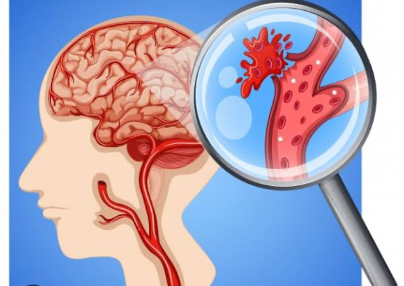 Catat Penderita Stroke Sebaiknya Rutin Lakukan 3 Jenis Olahraga Ini  