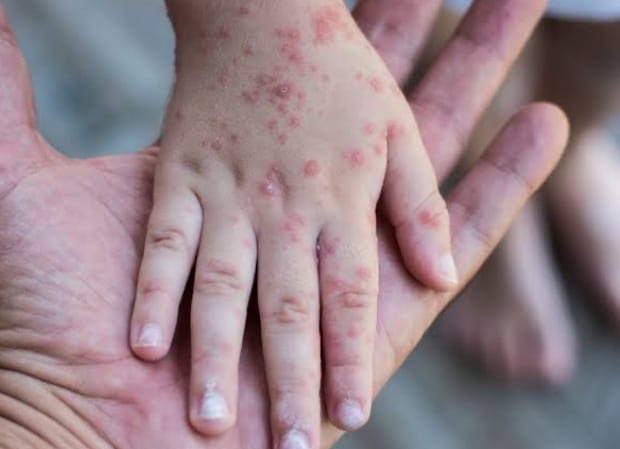 Cegah Penularan Campak pada Lebaran, Hindari Interaksi