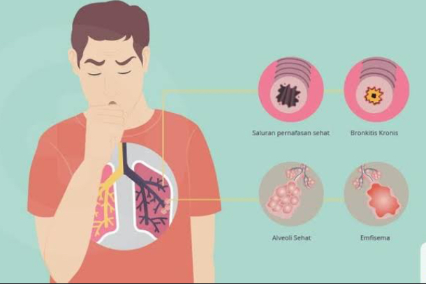 Waspada, Rokok Jadi Penyebab Utama Penyakit Paru Ostruksi Kronis