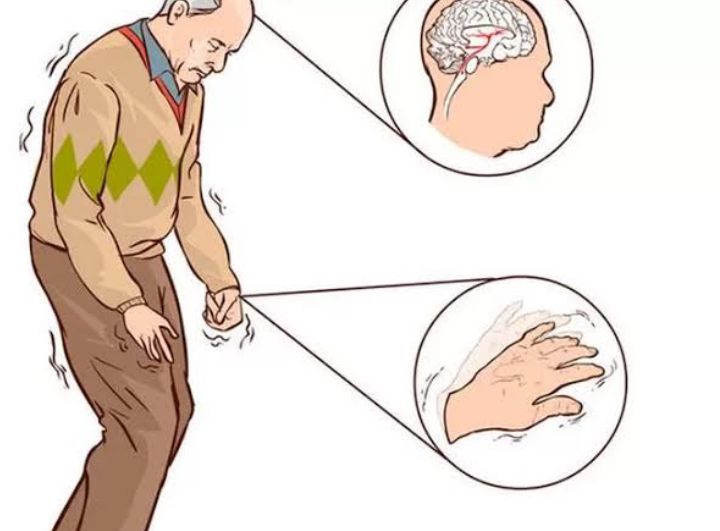 Obati Penyakit Parkinson dengan Rutin Mengonsumsi 7 Herbal Ini