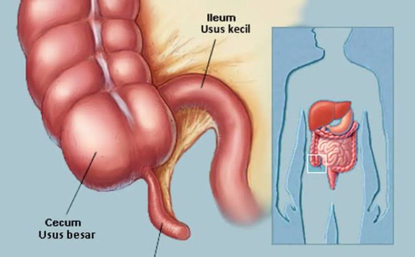 Tips Hidup Sehat Agar Terhindar Dari Penyakit Usus Buntu