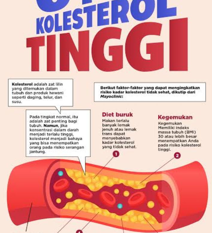 5 Tanda Kolesterol Tinggi Pada Perempuan Jarang Disadari, Apa Saja?