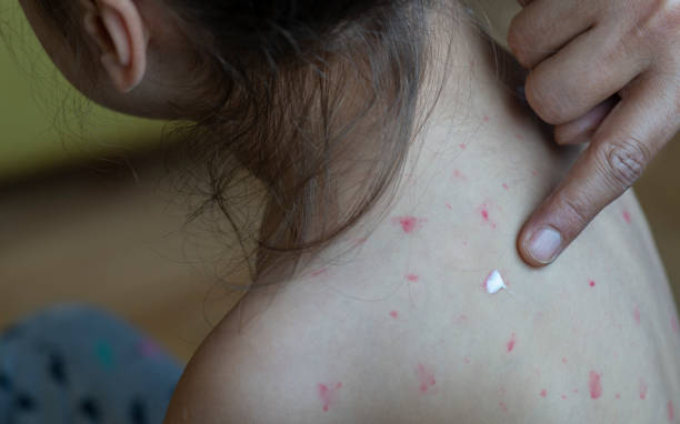 Apakah Campak Berbahaya? Kenali Gejala, Komplikasi, dan Pentingnya Imunisasi