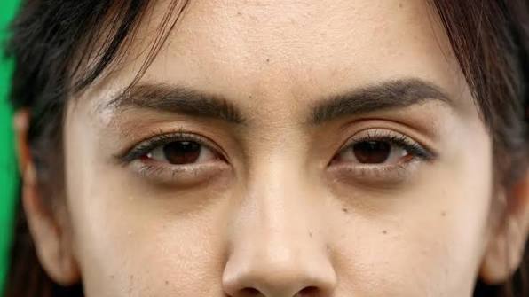 Cara Mencegah dan Menghilangkan Mata Panda agar Tidak Semakin Parah