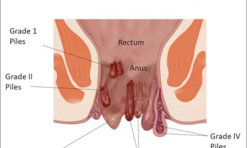 Cara Untuk Mengatasi Ambeien, Coba Obat Alami Ini