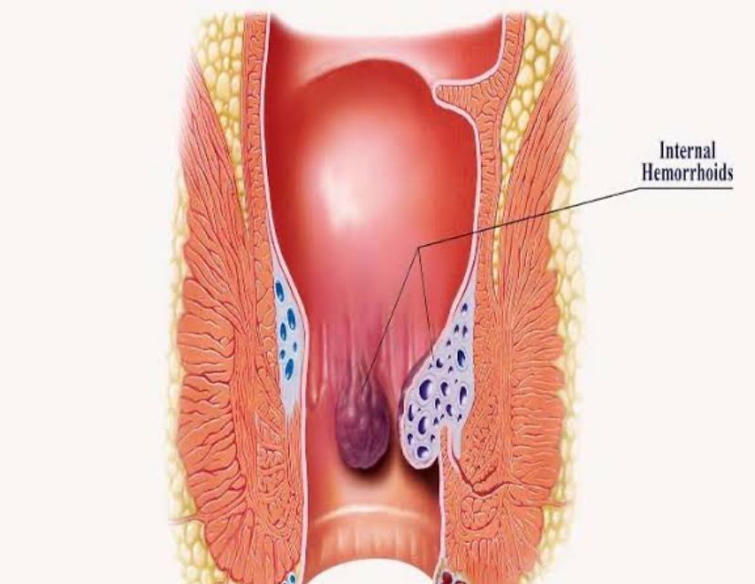 Cara Menghilangkan Benjolan Ambeien Secara Obat Alami dan Medis