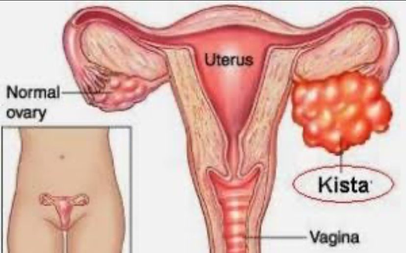 Cara mengecah Agar Terhindar Dari Penyakit Kista Ovarium