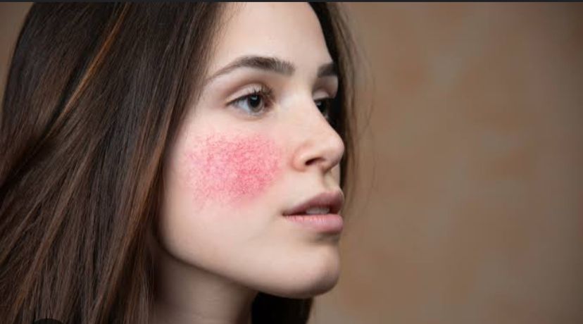 Kandungan Niacinamide Dalam Skincare Bisa Sebabkan Alergi, Simak Penjelasanya