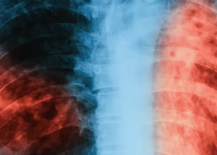 Bahan Alami untuk Mempercepat Penyembuhan Flek Paru-paru-Kata Dokter