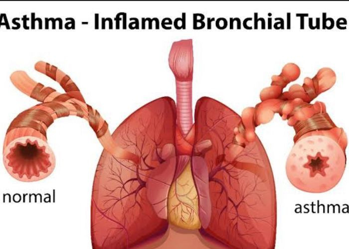 5 Rahasia Pengobatan Asma Dengan Ramuan Herbal Yang Jarang Diketahui