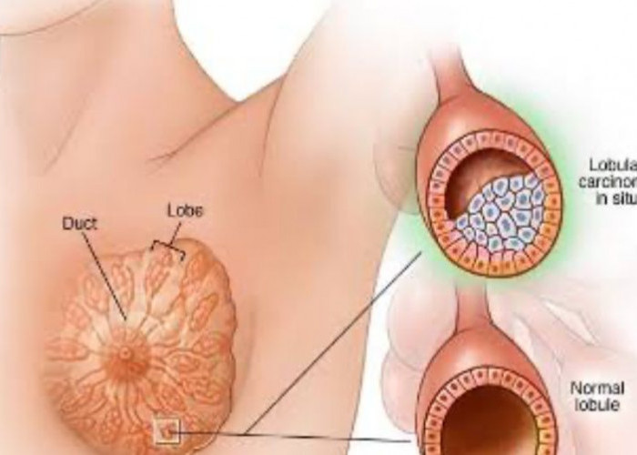 Cara Pengobatan Kanker Payudara Hingga Kiat Menghindari Perundungan