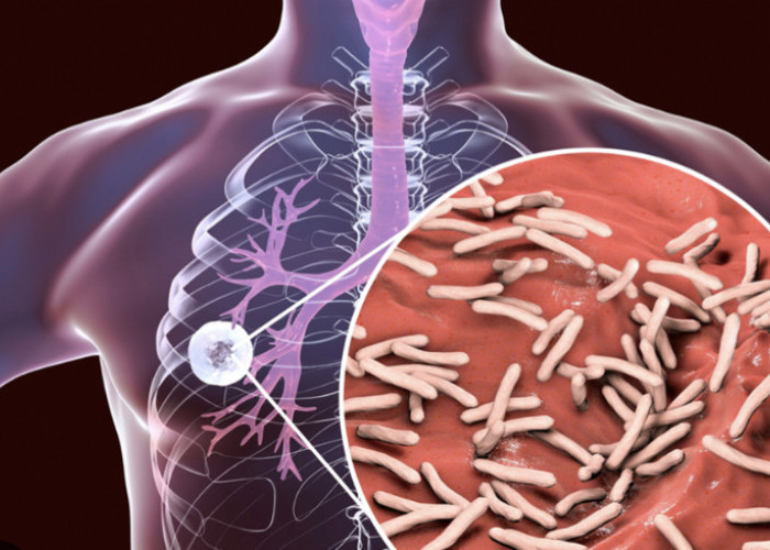 5 Faktor yang Membuat Bakteri TBC Mudah Berkembang di Tubuh