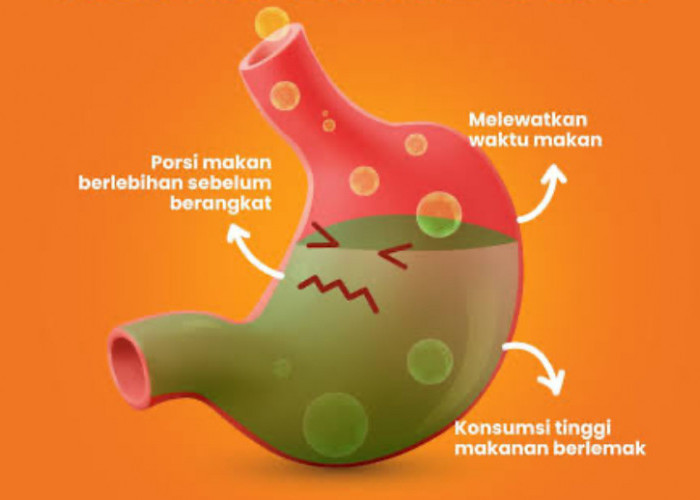 Mudik Aman Bagi Penderita GERD, Simak Saran Dokter