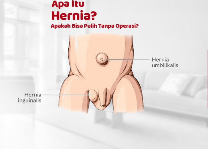 3 Pengobatan Alami untuk Penderita Hernia