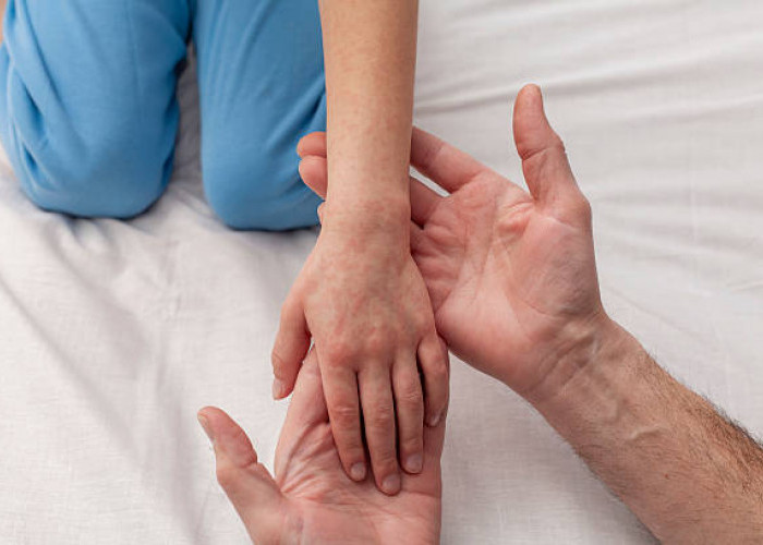  Dinkes Pastikan Lebong Aman dari Campak, Warga Diminta Tidak Lengah