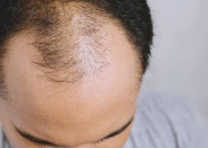Waspadai Kebotakan Pada Rambut Saat Usia Masih Muda, Kenali Penyebabnya