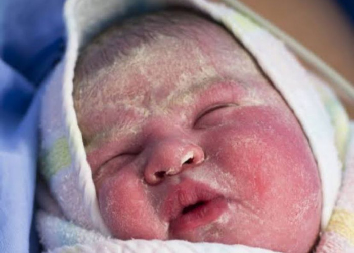Kebiasaan Bayi Yang Baru Lahir Kulit Mengelupas, Berikut Ini Cara Mengatasinya?