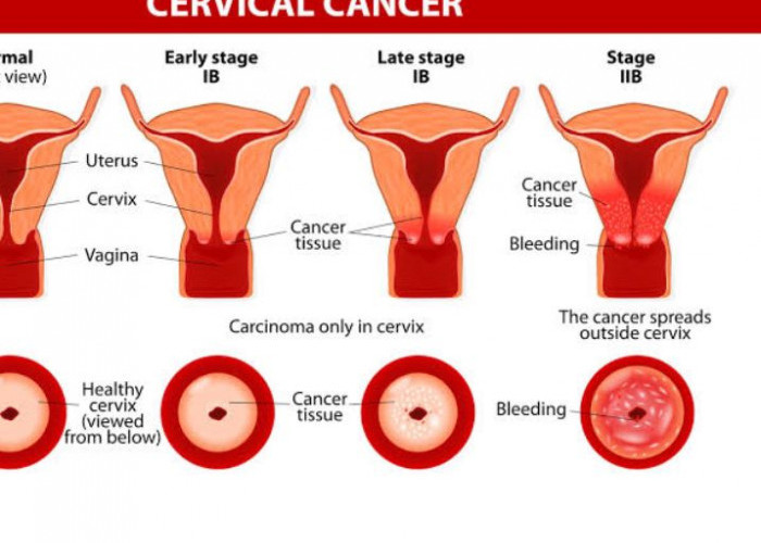 5 Hal yang Harus Anda Ketahui Mengenai Kanker Serviks