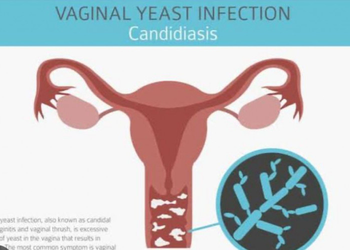 Obati Jamur yang Menyerang Daerah Kewanitaan dengan 5 Bahan Alami Ini
