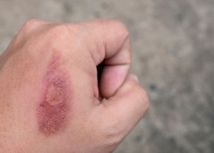 3 Cara Tepat Atasi Luka Bakar Knalpot Panas Tanpa Odol