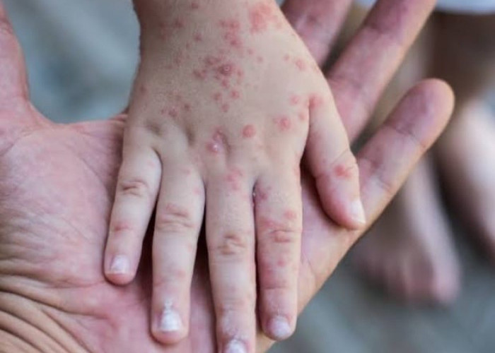 Cegah Penularan Campak pada Lebaran, Hindari Interaksi