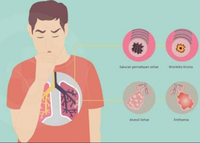 Waspada, Rokok Jadi Penyebab Utama Penyakit Paru Ostruksi Kronis