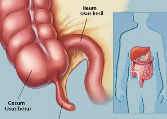 Tips Hidup Sehat Agar Terhindar Dari Penyakit Usus Buntu