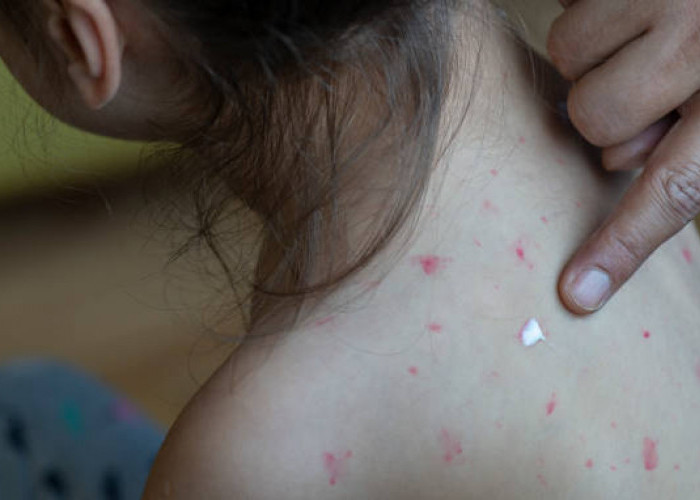 Apakah Campak Berbahaya? Kenali Gejala, Komplikasi, dan Pentingnya Imunisasi