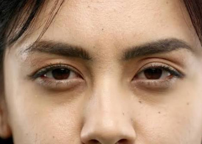 Cara Mencegah dan Menghilangkan Mata Panda agar Tidak Semakin Parah