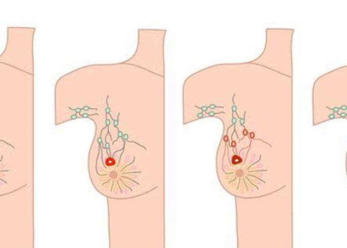 Deteksi Dini Kanker Payudara dengan 5 Cara Ini, Perempuan Wajib Tahu